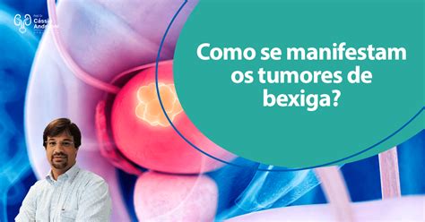 Como se manifestam os tumores de bexiga Dr Cássio Andreoni