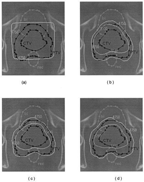 Prediction Of The Benefits From Dose Escalated Hypofractionated