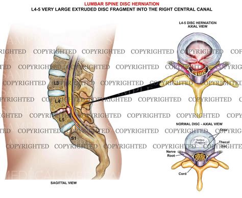 L4 5 Lumbar Spine Disc Herniation Medical Art Works