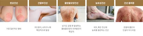 피부질환클리닉-건선 – 코스비한의원