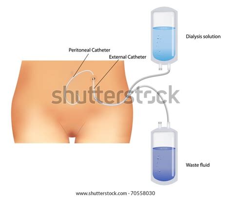 Vector Peritoneal Dialysis Procedure Used Renal Stock Vector (Royalty Free) 70558030