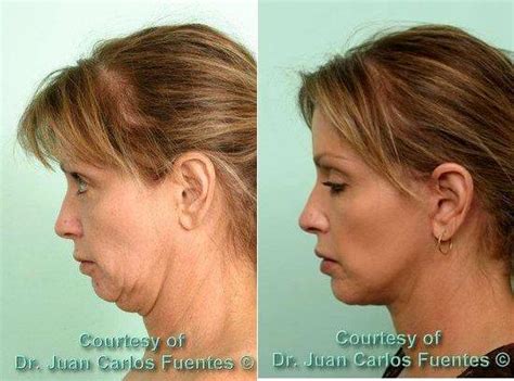 Dr Juan Carlos Fuentes Md Mexico Plastic Surgeon Facelift