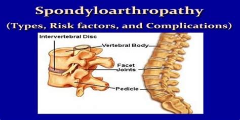 Spondyloarthropathy (Types, Risk factors, and Complications ...