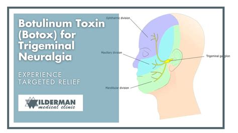 Botulinum Toxin (Botox) for Trigeminal Neuralgia - Wilderman Clinic