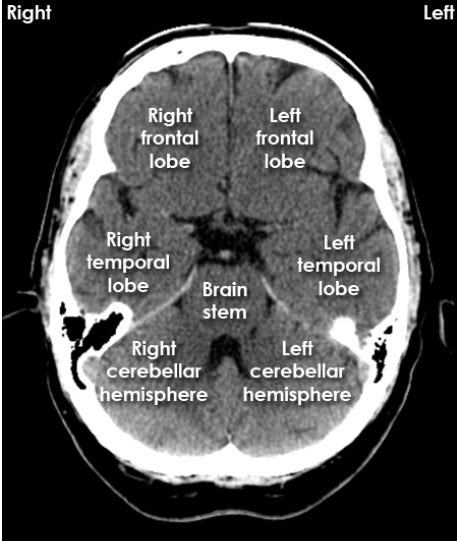 Brain Ct