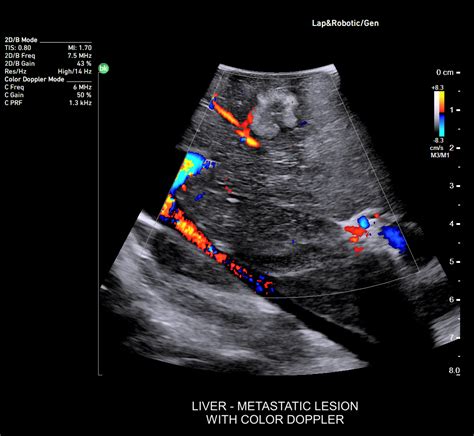 Bkactiv General Surgery Ultrasound Machine Bk Medical