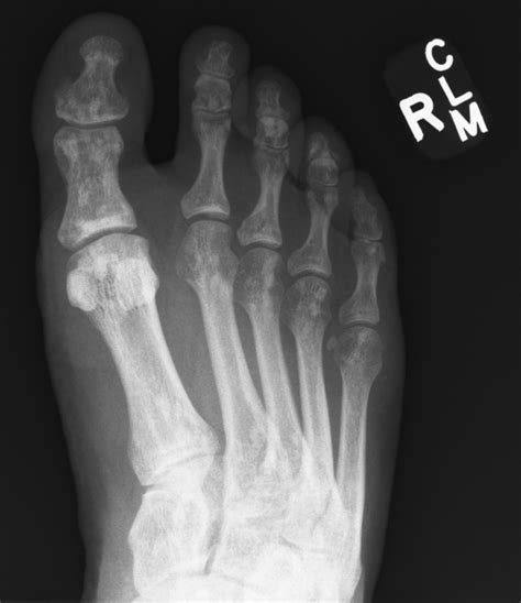 Osteopoikilosis Of The Foot Radiology Case Radshare Net