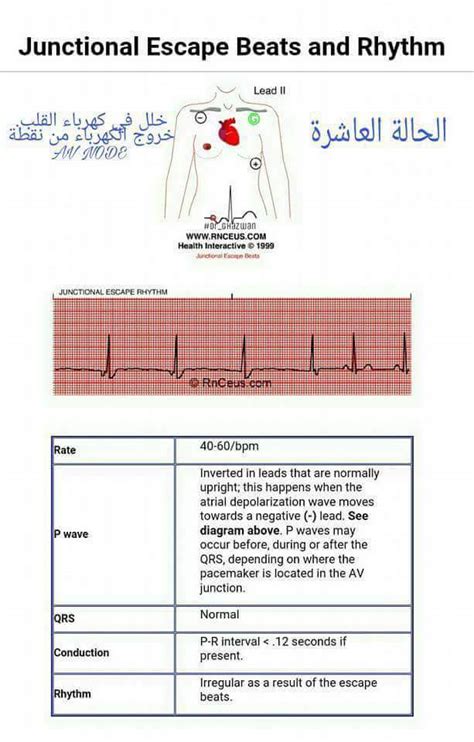 تعلم معنا ؟ كيف تقرا تخطيط القلب Ecg