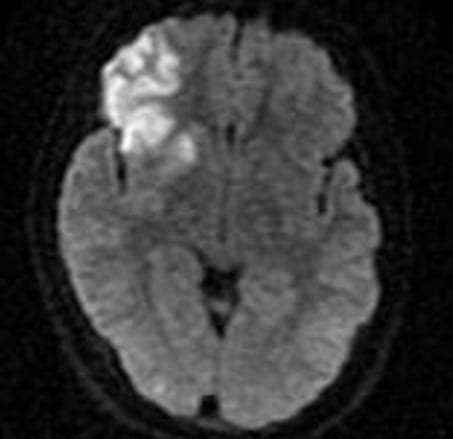 Acute Ischemic Stroke in a Pediatric Patient - The Western Journal of ...