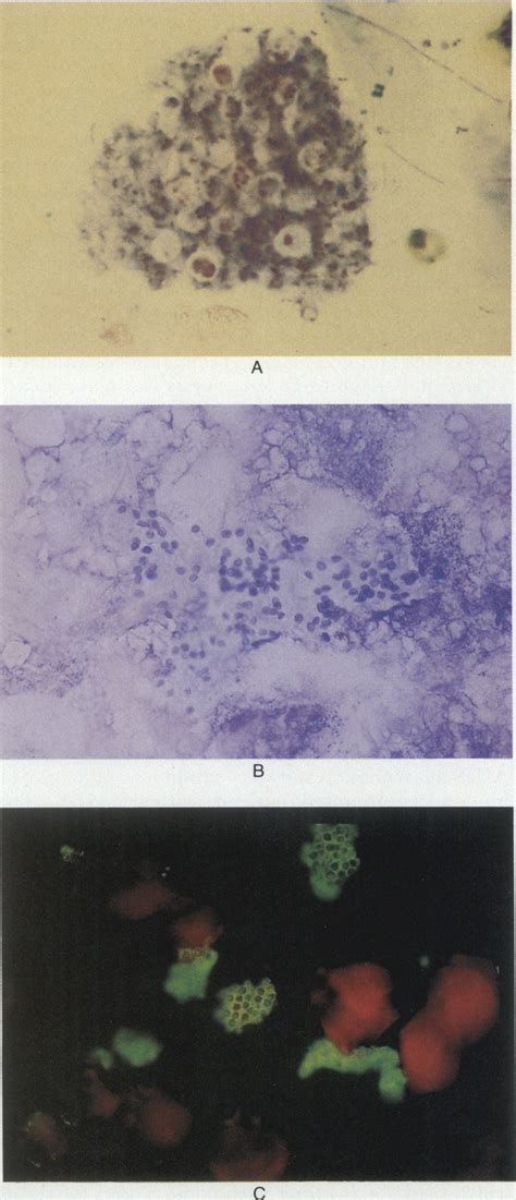 Diagnosis Of Pneumocystis Carinii Pneumonia Improved Detection In Sputum With Use Of Monoclonal