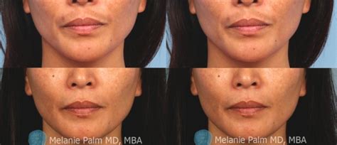 Morpheus8 radio-frequency micro-needling before and after picture