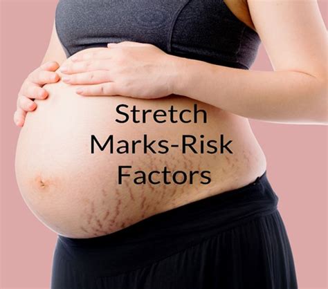 Risk Factors And Precautions For Stretch Marks Ask The Nurse Expert