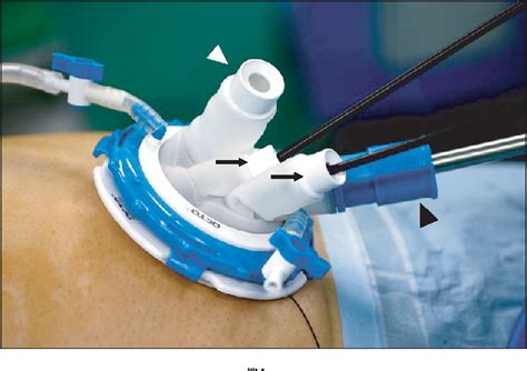 Figure 1 From The Single Incision Laparoscopic Intragastric Wedge