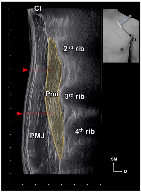 Toxins Free Full Text Ideal Injection Points For Botulinum Neurotoxin For Pectoralis Minor