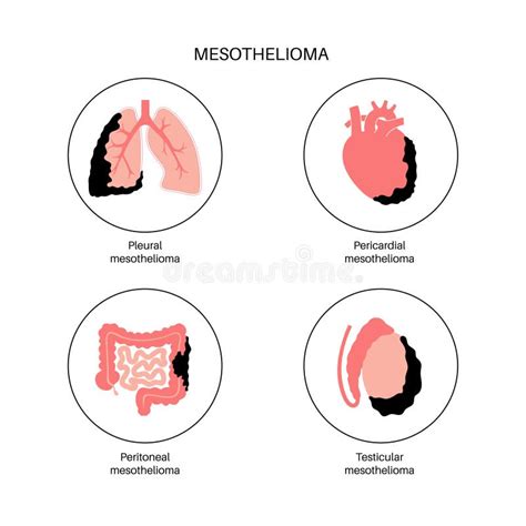 Mesothelioma Tumor Types Stock Vector Illustration Of Intestine