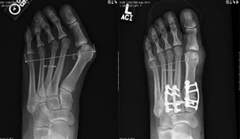 A Systematic Approach To The Surgical Correction Of Combined Hallux