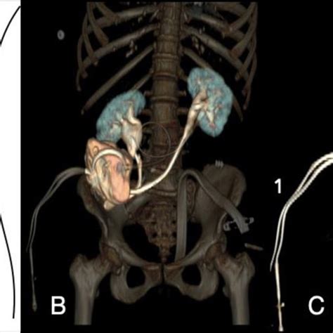 Pdf Urinary Diversion After Pelvic Exenteration For Gynecologic