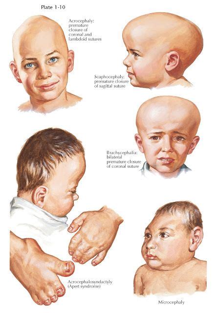 Floppy Baby Syndrome Causes Symptoms And Treatments Artofit