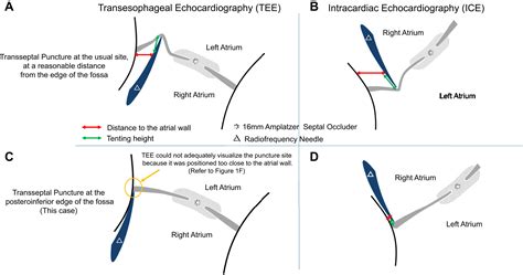 Intracardiac Echocardiography Guided Transseptal Puncture Invisible By