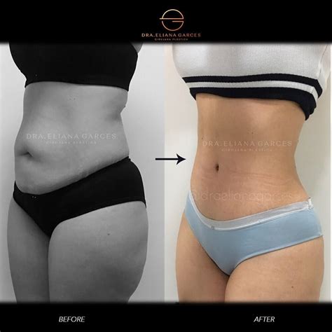 Antes Y Despu S Abdominoplastia De Eliana Garc S