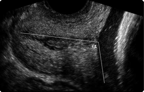 Cervical Ripening With A Foley Catheter The Role Of Pre And