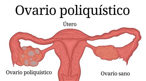 Todo lo que tienes que saber del síndrome de ovario poliquístico