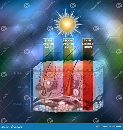 Skin Burn Classification Cartoon Vector 50132291