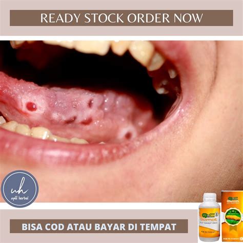 Jual Obat Sariawan Parah Kanker Mulut Stomatitis Aftosa Canker Sore