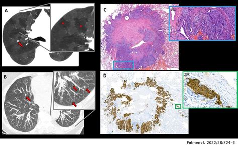 Diffuse Idiopathic Pulmonary Neuroendocrine Cell Hyperplasia A Rare