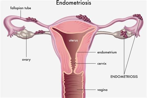 Ovarian Cysts During Pregnancy Types Symptoms Treatments Momjunction