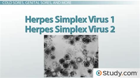 Chickenpox Herpes And Mono Diseases Of The Herpesviridae Virus