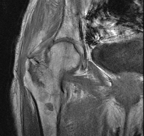 Incomplete Intertrochanteric Fracture Occult Image Radiopaedia Org