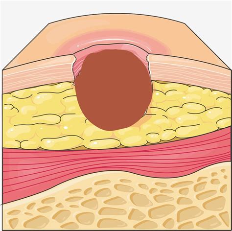 Abscess Model Creative Diagnostics