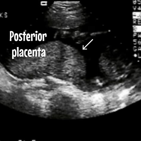 Everything about the placenta. Ultrasound included. - Ultrasoundfeminsider