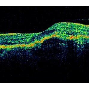 Spectral Domain Optical Coherence Tomography A And Time Domain