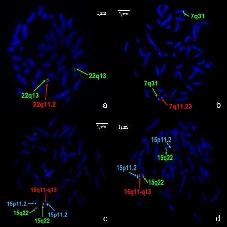 The metaphases FISH showing deletion hybridization pattern of (a)... | Download Scientific Diagram