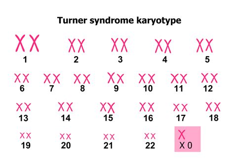 10 Symptoms of Turner Syndrome - Facty Health