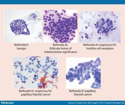 Molecular Diagnosis For Indeterminate Thyroid Nodules On Fna