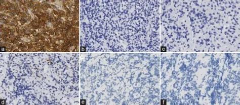 What Are Thyrotroph Adenomas Pathosomes