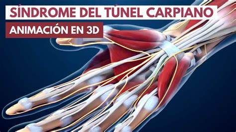 Síndrome del túnel carpiano Animación en 3D YouTube