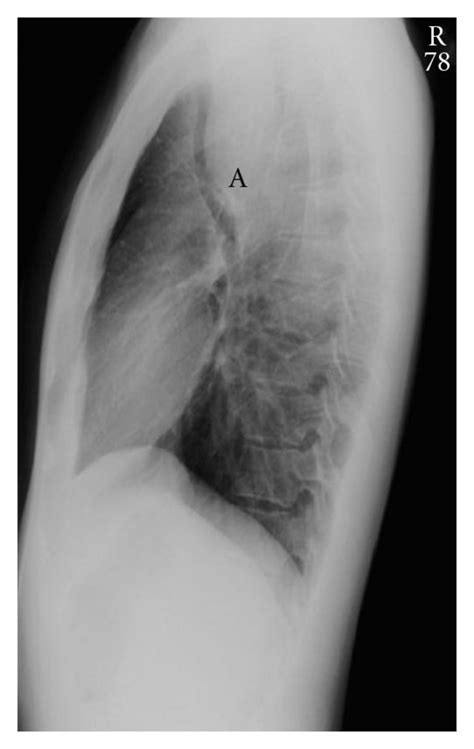 Chest X Ray AP A And Lateral B Views Showing A Large Mediastinal