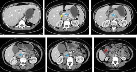 Mirizzi syndrome – Radiology Cases