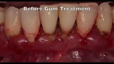 Treatment Of Advanced Gum Disease Case 3 Youtube