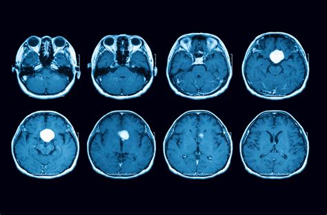 Advanced Therapies for Malignant Brain Tumors - Hera BioLabs