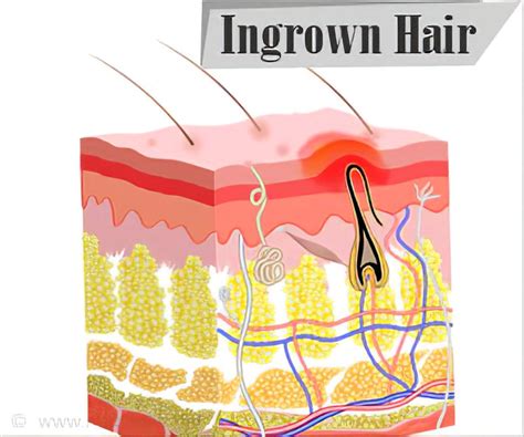 Ingrown Hair Diagram