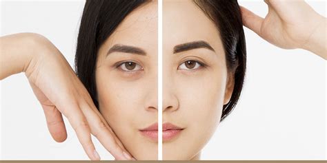 Microdermabrasion Vs Chemical Peels Which Is For You