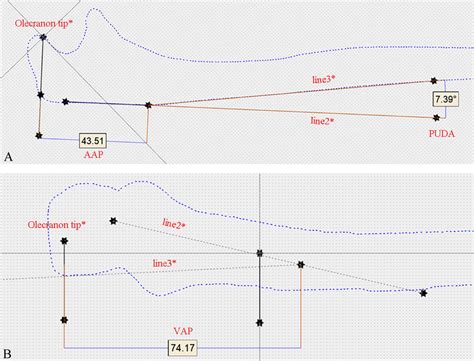 The Measurement Of Anterior Angulation Puda Tip To Apex Distance