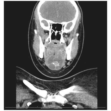 Axial (a) and coronal (b) computed tomography (CT) scan images of ...