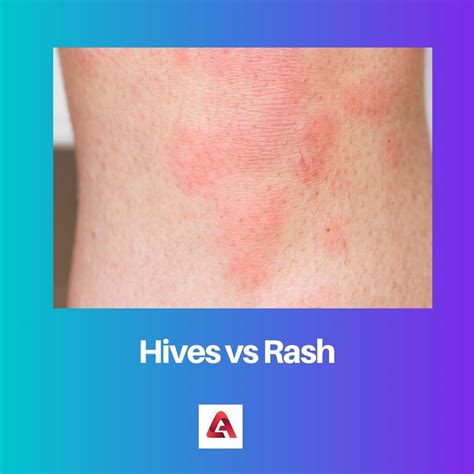 Hives Vs Rash Difference And Comparison