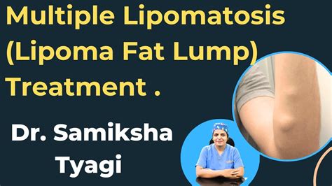 Multiple Lipomatosis Lipoma Fat Lump Treatment Youtube